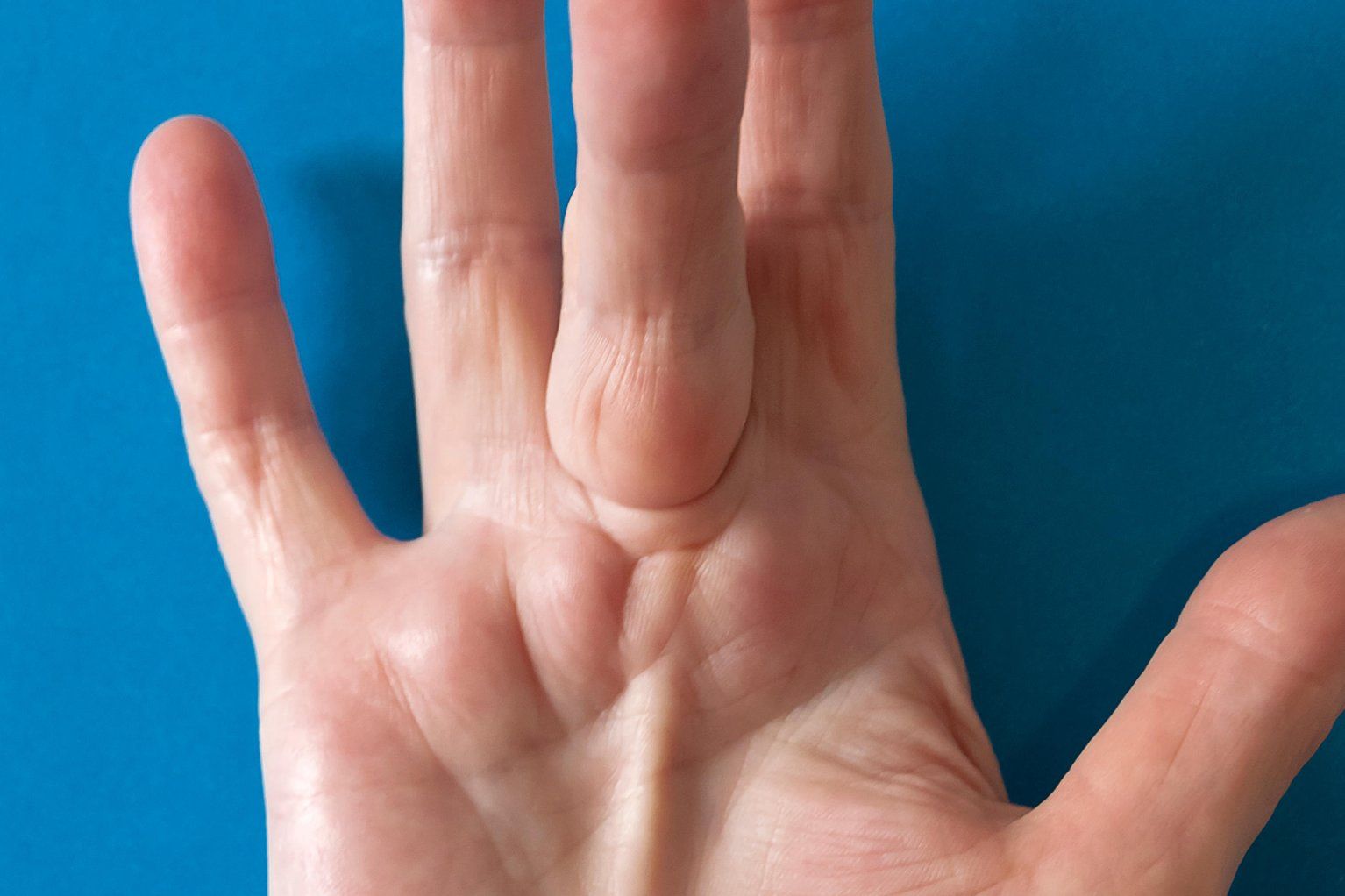 Dupuytren's Contracture
