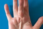 Dupuytren's Contracture